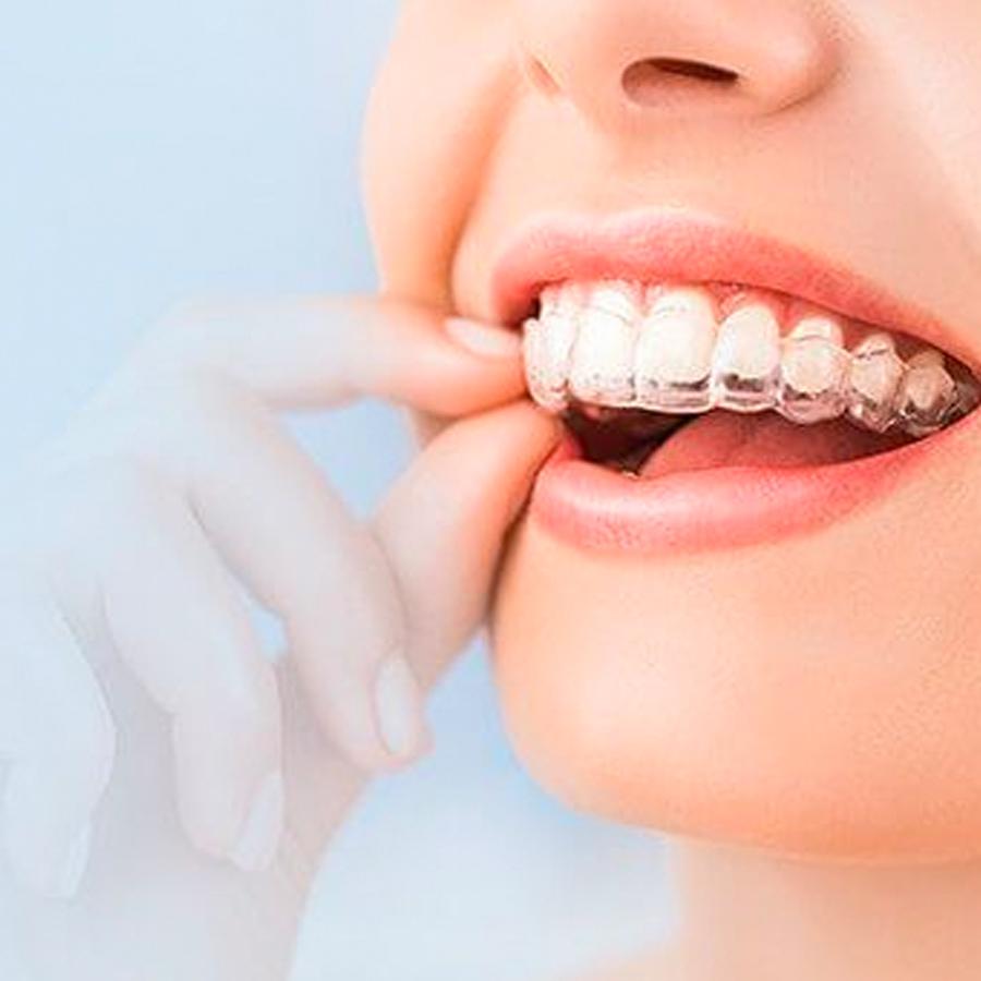 Invisalign clear aligners to straighten teeth